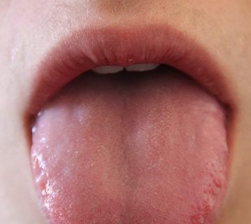 Zungenbelag – entfernen oder nicht?